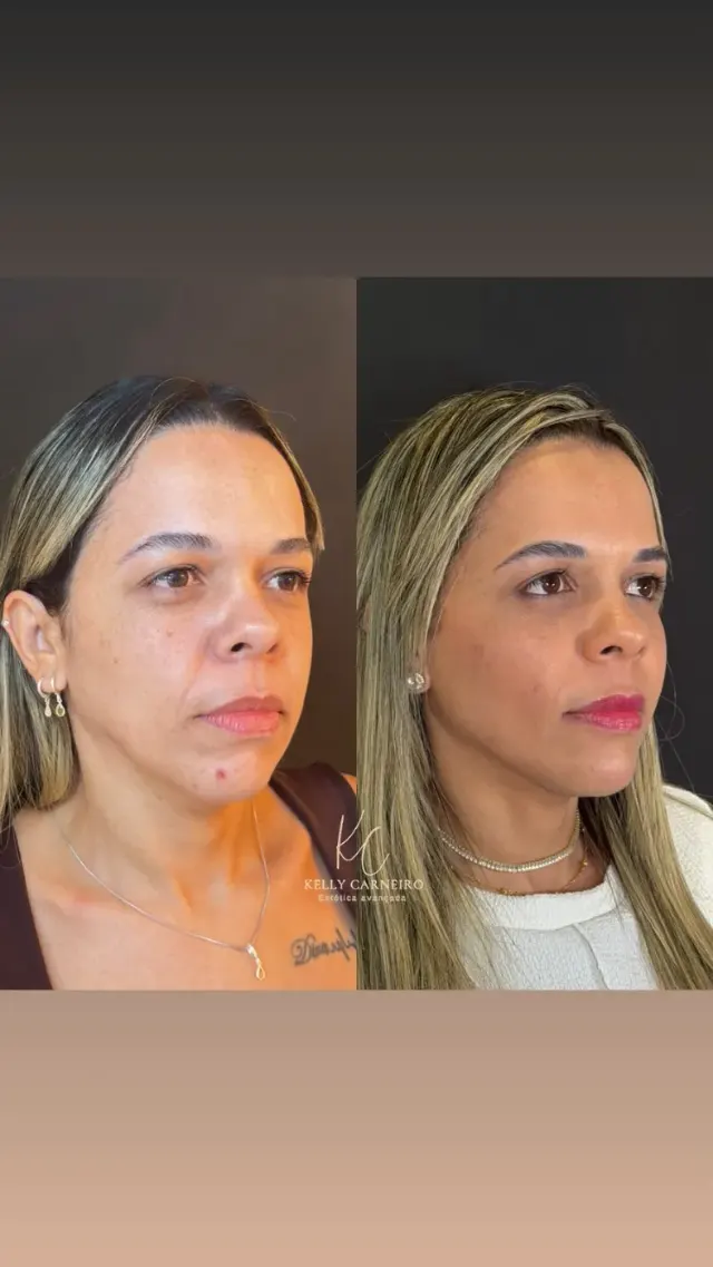 Antes e depois de procedimento de harmonização facial em Contagem, paciente 1