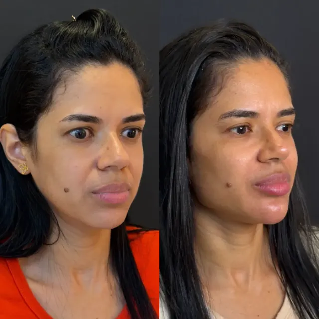 Antes e depois de procedimento de harmonização facial em Contagem, paciente 4
