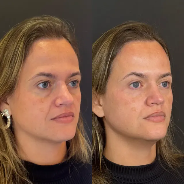 Antes e depois de procedimento de harmonização facial em Contagem, paciente 7