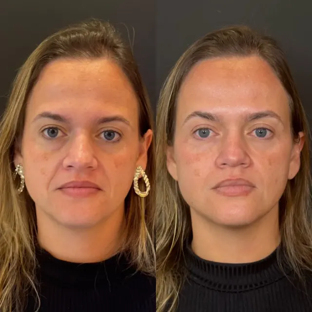 Antes e depois de procedimento de harmonização facial em Contagem, paciente 8