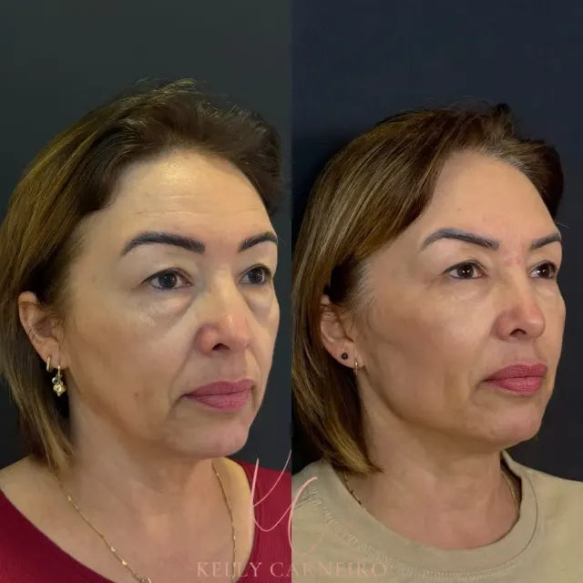 Antes e depois de procedimento de harmonização facial em Contagem, paciente 11