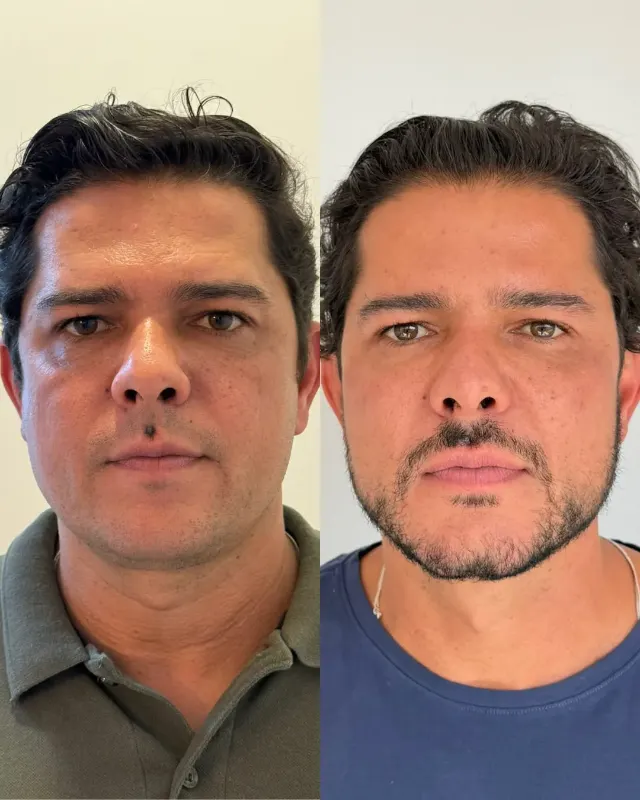 Antes e depois de procedimento de harmonização facial em Contagem, paciente 12
