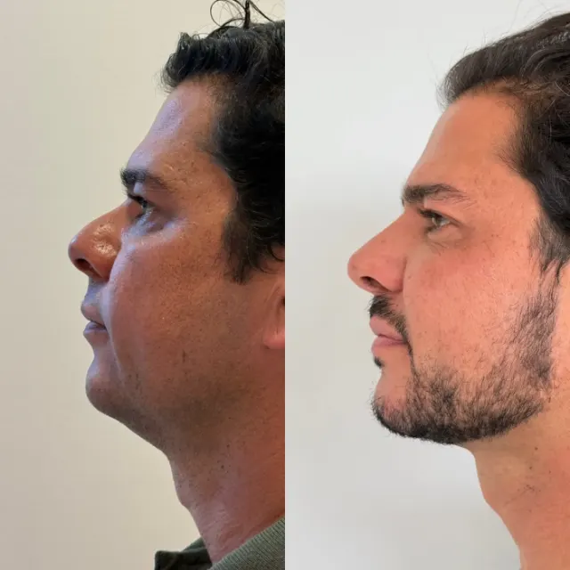 Antes e depois de procedimento de harmonização facial em Contagem, paciente 13
