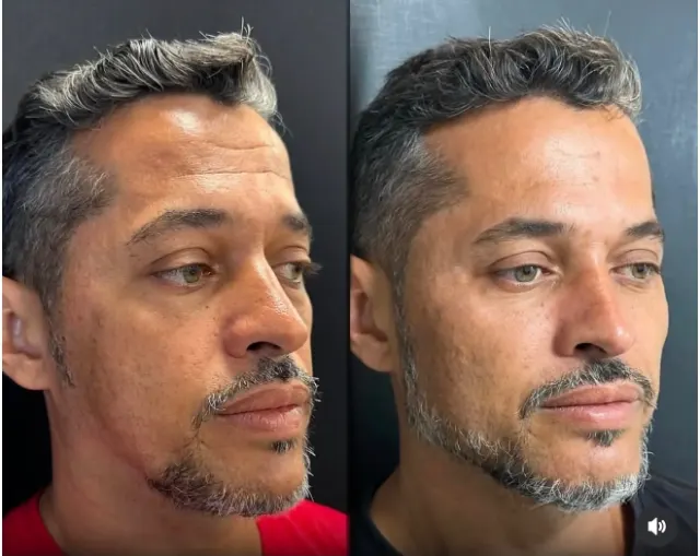Antes e depois de procedimento de harmonização facial em Contagem, paciente 14