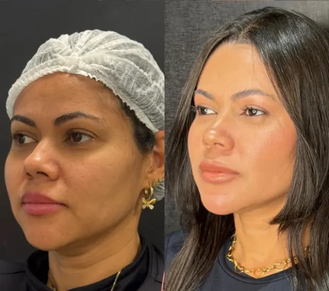 Antes e depois de procedimento de harmonização facial em Contagem, paciente 16