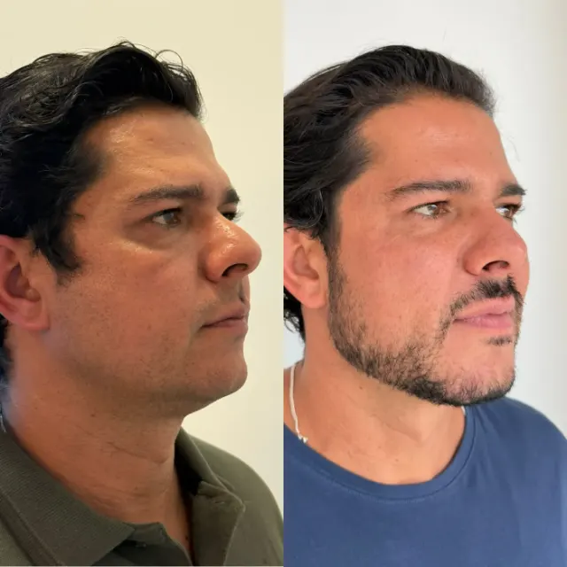 Antes e depois de procedimento de harmonização facial em Contagem, paciente 18