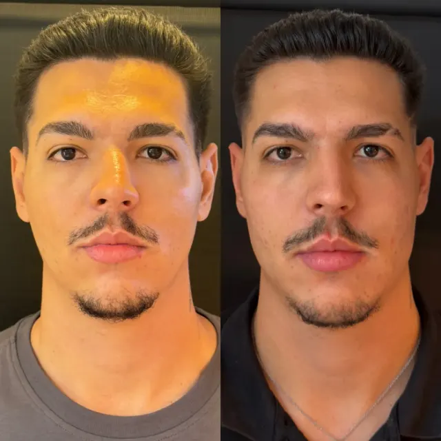 Antes e depois de procedimento de harmonização facial em Contagem, paciente 19