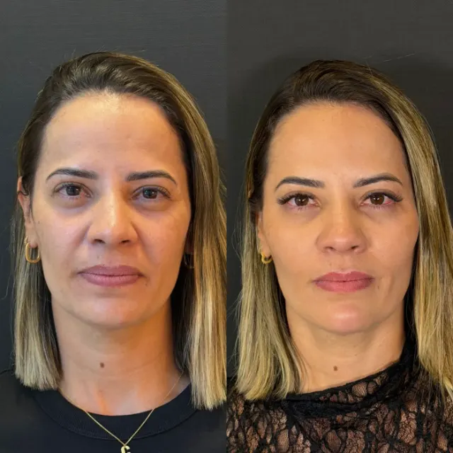 Antes e depois de procedimento de harmonização facial em Contagem, paciente 21