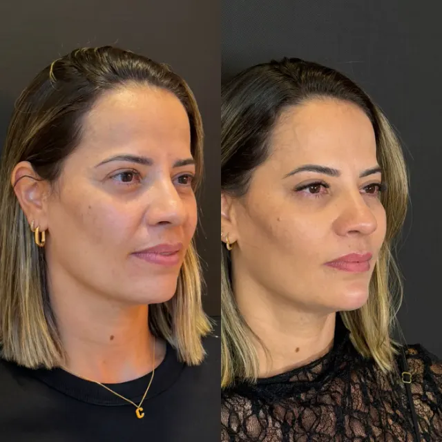 Antes e depois de procedimento de harmonização facial em Contagem, paciente 22